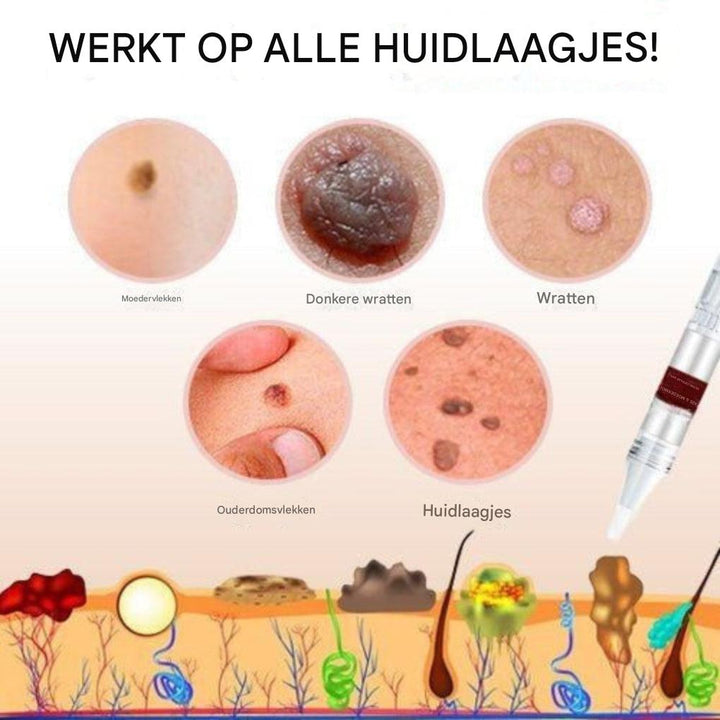 Tags en moedervlekkenverwijderaar