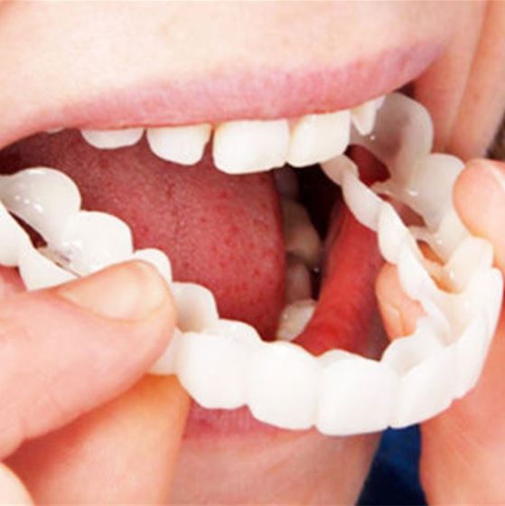 Opsteek-veneers | Flexibele, lijmvrije pasvorm voor maaltijden en dagelijks gebruik