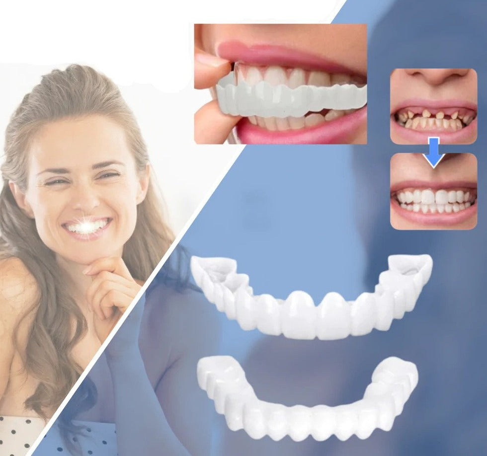Opsteek-veneers | Flexibele, lijmvrije pasvorm voor maaltijden en dagelijks gebruik