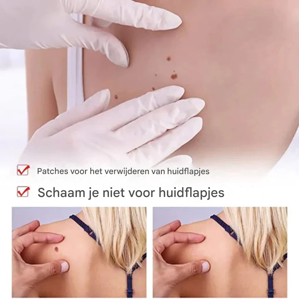 Tags en moedervlekkenverwijderaar